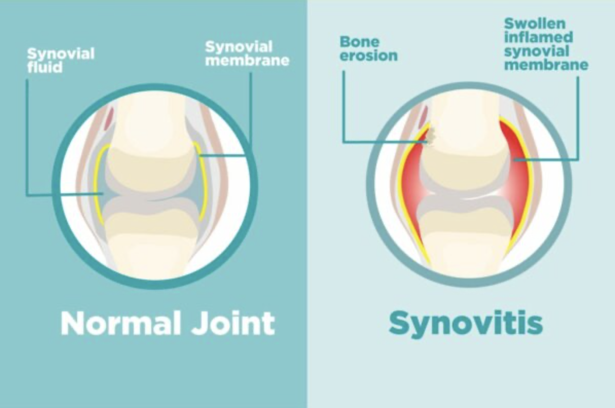 What is Synovitis? | Rheumatoid Arthritis Coach