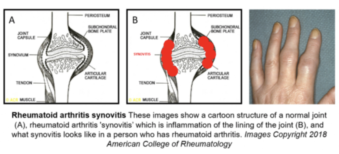 What is Synovitis? | Rheumatoid Arthritis Coach